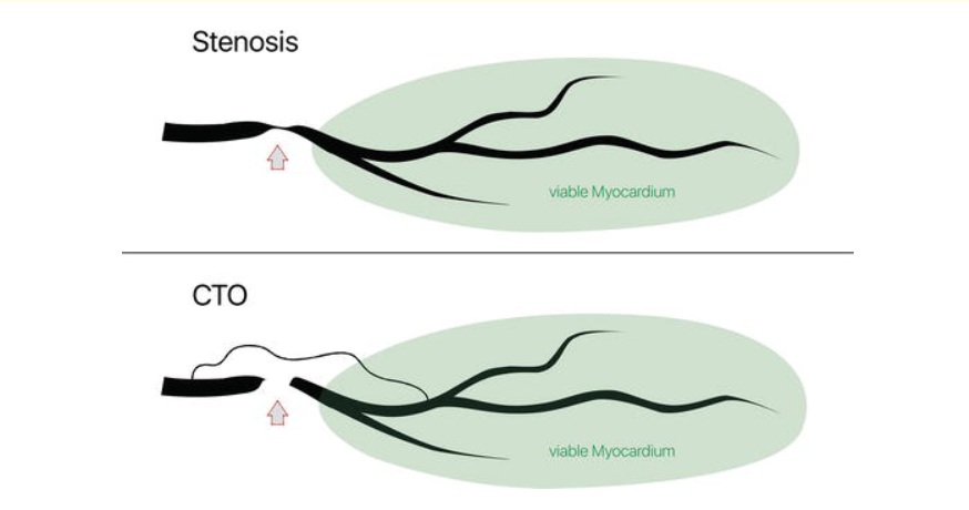 慢性完全冠状动脉阻塞 CTO：一定需要做心脏搭桥手术吗?