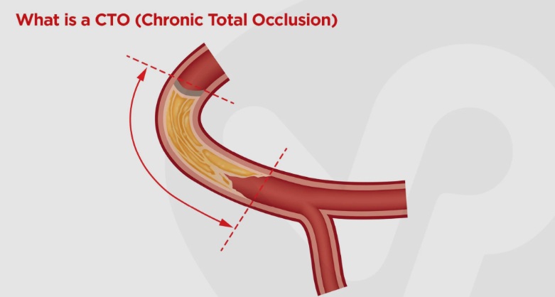 Chronic Total Occlusion (CTO): Is Bypass Surgery the Only Option?