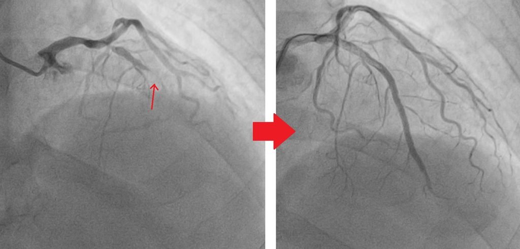 Complex angioplasty